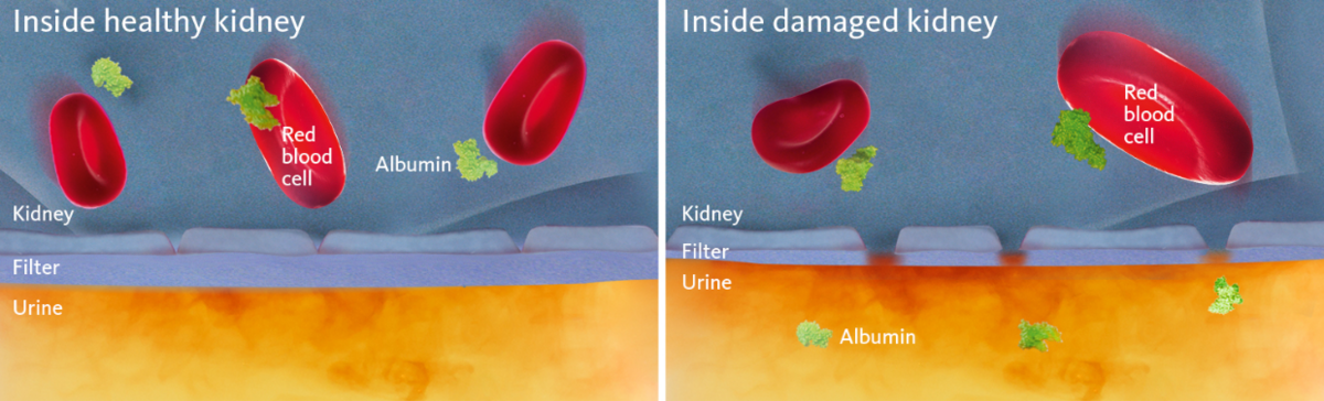 [.CZ-cz Czech Republik (czech)] •	Schematic and simplified view of a healthy and a damaged kidney membrane with the latter illustrating the cause of albuminuria.